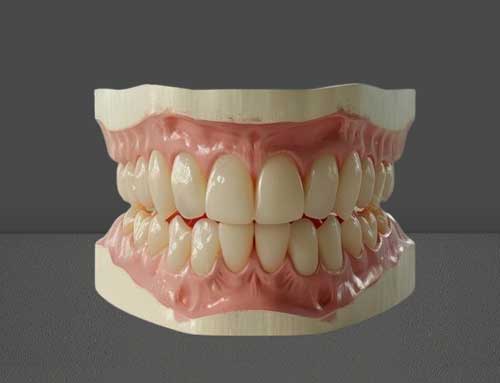 Complete dentures