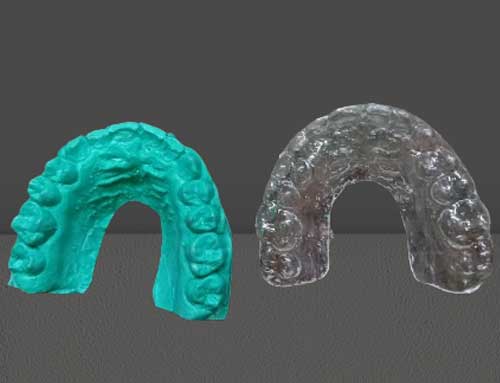 Essix retainer