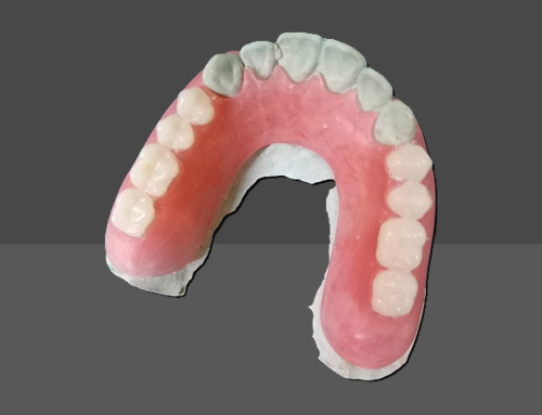 Removable partial dentures