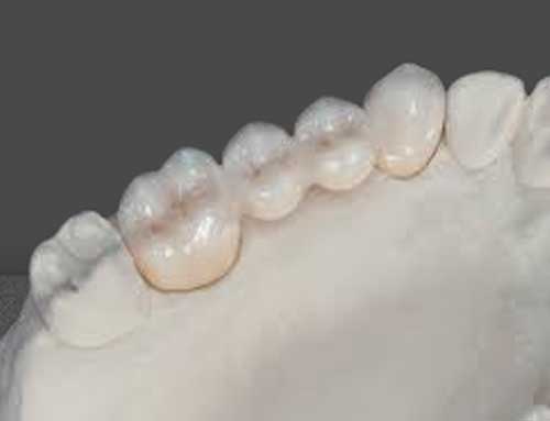 Monolithic Zirconia